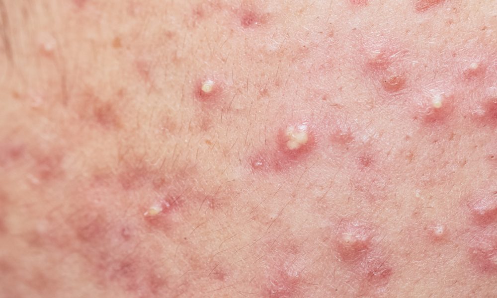 acne-principales-tipos-y-conceptos-erroneos-1920