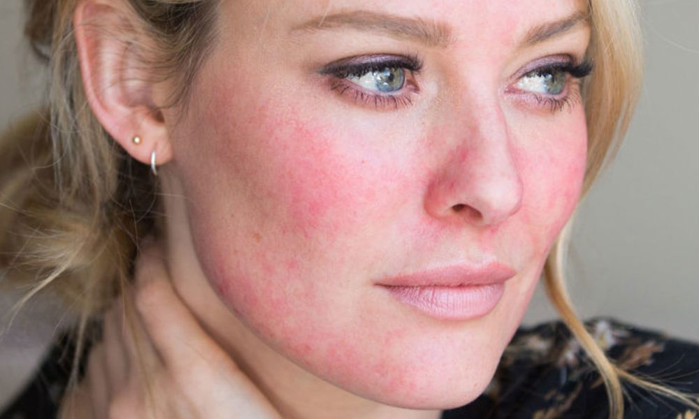 rosacea enfermedad crónica de la piel que afecta al 10 de la población